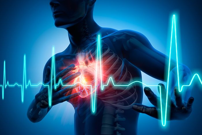 Muertes en su mayoría son por Insuficiencia cardiaca.