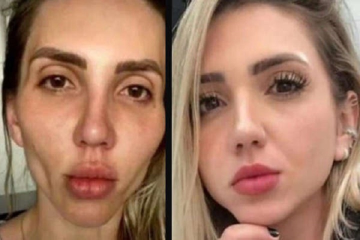 "Me convertí en una calavera; nadie me advirtió": tiktoker lamenta cirugía en su rostro