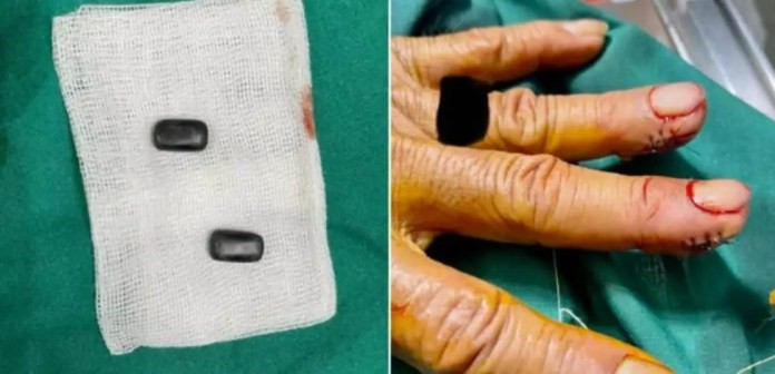 Para manipular los dados, un hombre implantó imanes en sus dedos.