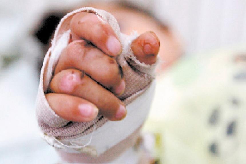 Tragedia en Garzón: niño de 5 años con graves quemaduras lucha por su vida en Neiva