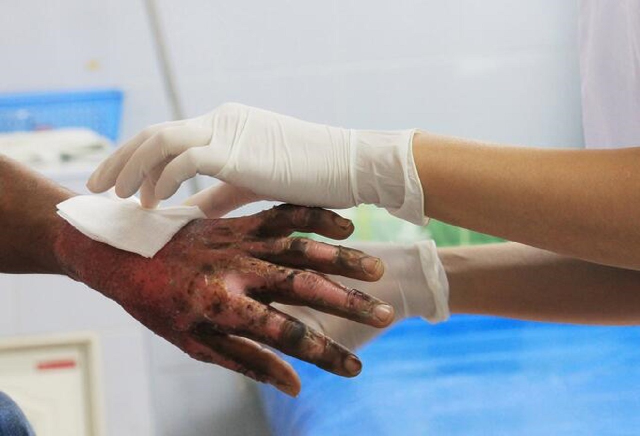 Huila registra 8 lesionados por pólvora; 38% resultó herido solo por observar los artefactos