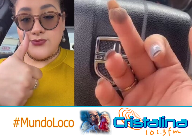 ¡INCREÍBLE! LE CRECIÓ VELLO PÚBICO EN UN DEDO POR CULPA DE UN INJERTO DE PIEL