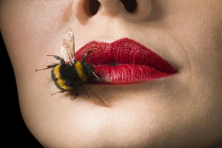 Se realizó un tratamiento estético y la boca le quedó como si la hubiese picado una abeja