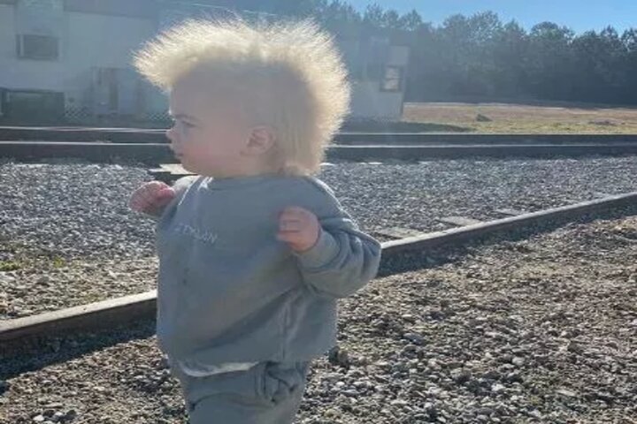 Tiene 1 año y sufre del 'síndrome del cabello impeinable'