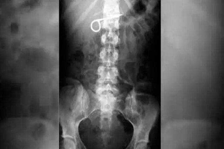Preso se tragó dos tijeras, una cuchara y un cepillo, pero se negó a recibir atención médica