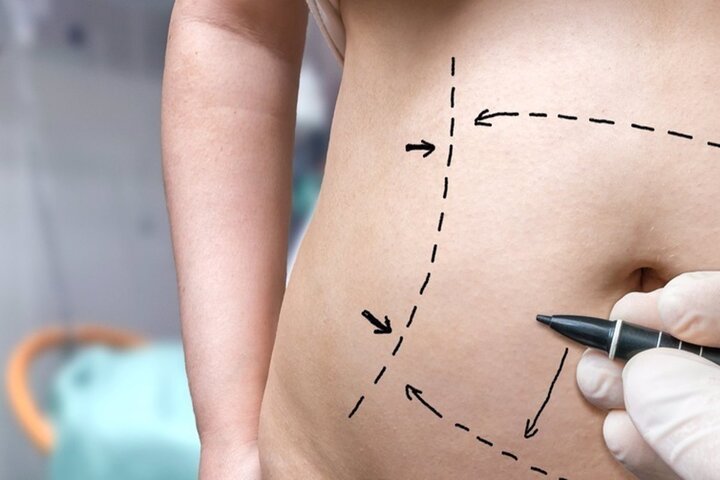 Una mujer fingió tener ‘cáncer’, para gastar el dinero en una cirugía estética