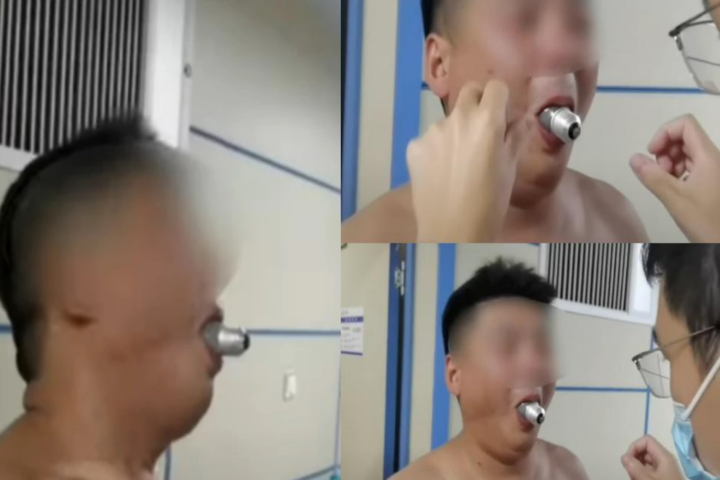 Terminó con un bombillo atorado en su boca por reto viral