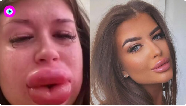 Modelo se hizo un "pequeño" retoque de labios y ahora no puede ni hablar