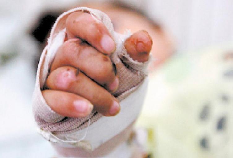 Niño de 4 años se quemó accidentalmente