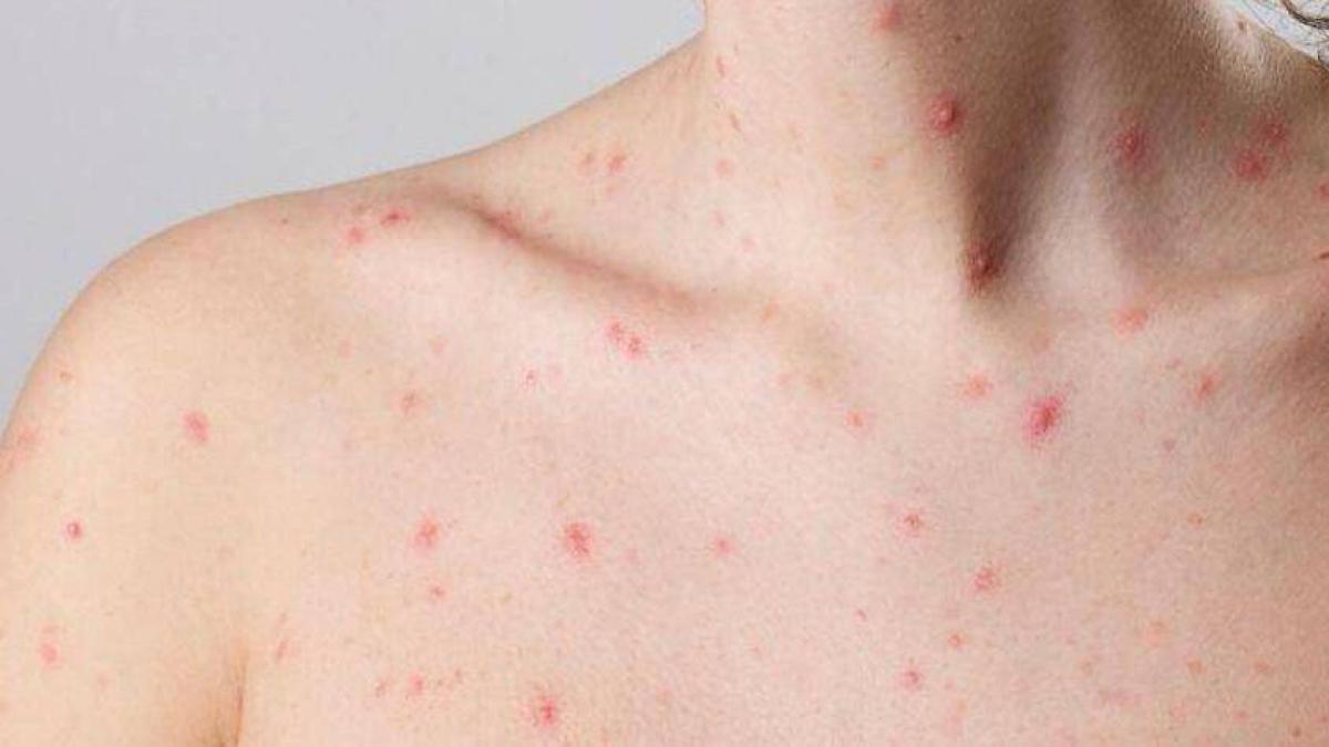 [AUDIO] Variante clado I de la Viruela del mono o Mpox no ha sido detectada en Colombia
